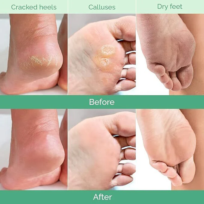 Foot Peel Mask with Peach by Plantifique - 2 Pack Foot Mask Dermatological - Image 3